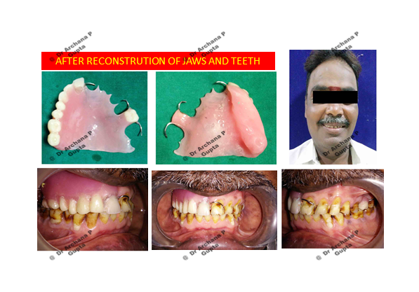 Palatal obturator fabricated by Dr Archana Gupta for same case.