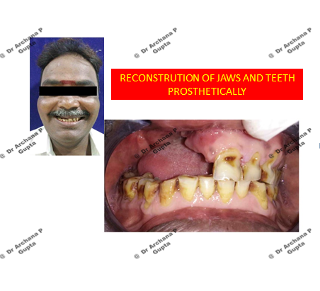 Patient with oro-nasal communication-Missing upper teeth and jaw on one side-Before.
