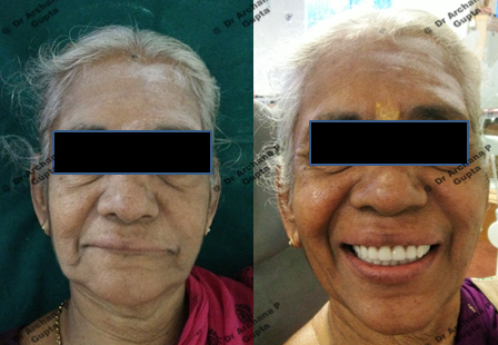 Case done by Dr Archana Gupta at our clinic-Before after comparison.