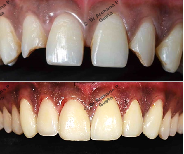 Dental veneer used to close spaces in between upper front teeth and modify colour. Case done at our clinic-Before after comparison.