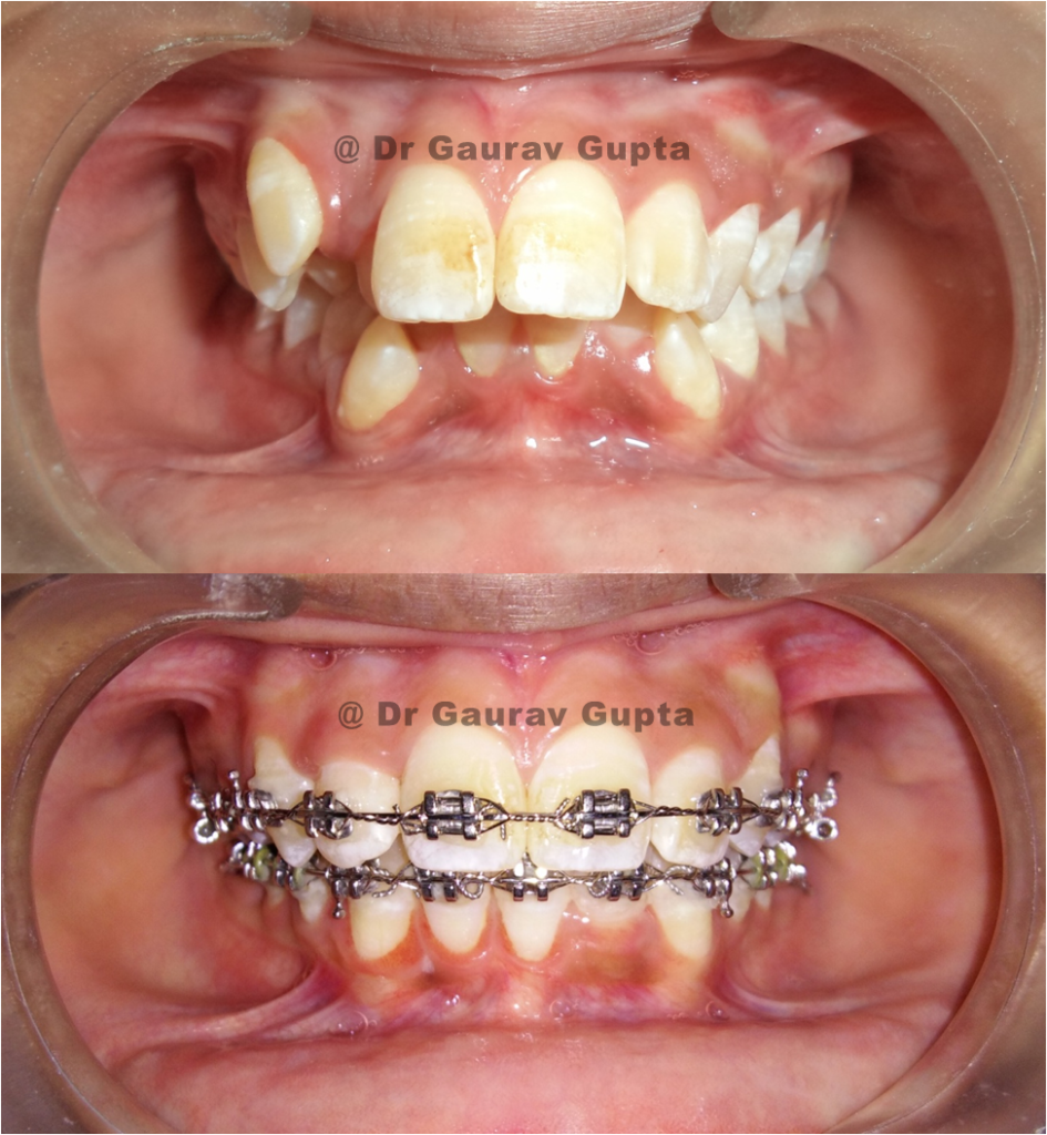 Case done by Dr Gaurav Gupta at our clinic-Before after comparison.