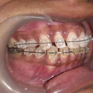 Case done by Dr Gaurav Gupta at our clinic.