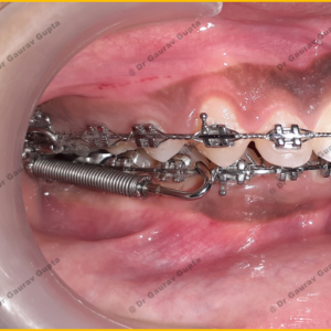 Case done by Dr Gaurav Gupta at our clinic.