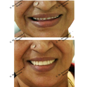Types of dentures