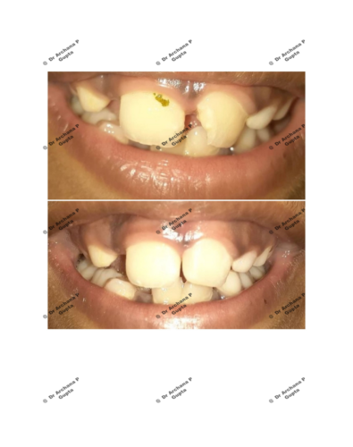 Tooth coloured filling done for fractured front tooth of a child at our clinic by Dr Archana Gupta-Before after.