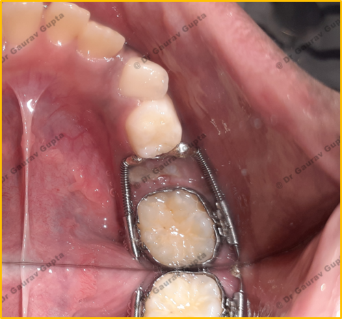 Device put in mouth of a child to create space for erupting teeth by Dr Gaurav Gupta 