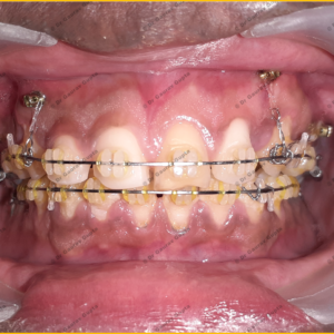 Case done by Dr Gaurav Gupta at our clinic.