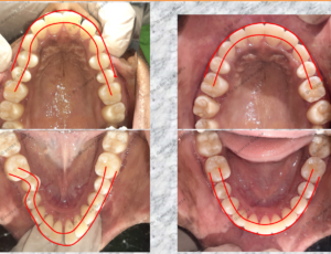 Case done by Dr Gaurav Gupta at our clinic-Before after comparison.