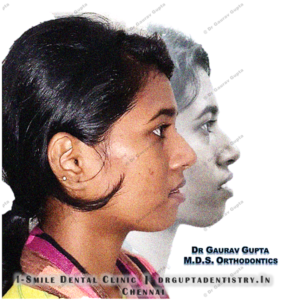 Face profile correction-Case done by Dr Gaurav Gupta at our clinic-Before after comparison