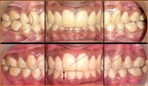 Case done by Dr Gaurav Gupta at our clinic-Before after comparison