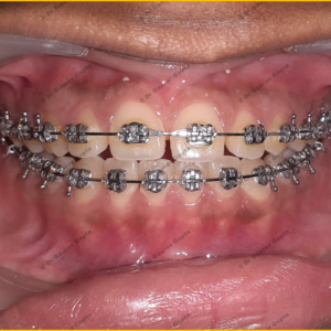 Case done by Dr Gaurav Gupta at our clinic.