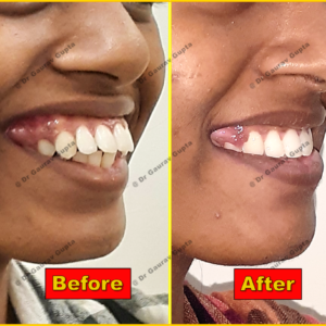 Case done by Dr Gaurav Gupta at our clinic-Before after comparison.