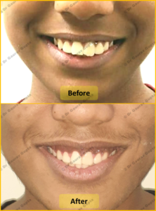 Case done by Dr Gaurav Gupta at our clinic-Before after comparison.