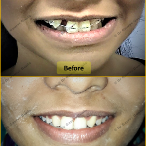 Case done by Dr Gaurav Gupta at our clinic-Before after comparison.