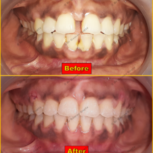 Case done by Dr Gaurav Gupta at our clinic-Before after comparison.