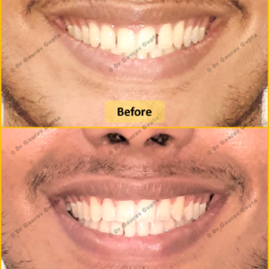 Case done by Dr Gaurav Gupta at our clinic-Before after comparison.