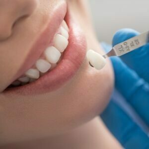 Tooth coloured fillings