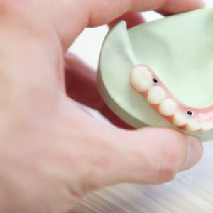 Replacement for lost teeth