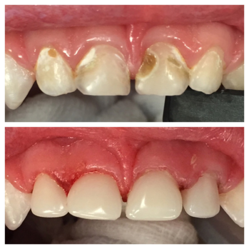 Child with aggressive caries treated at our clinic by Dr Archana Gupta-Before after.
