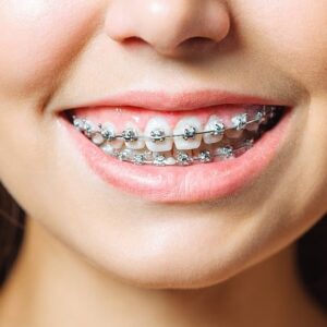 Metal | Ceramic | Lingual | Invisalign