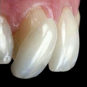 Aesthetic solution for discoloured teeth