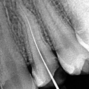 Save and restore teeth