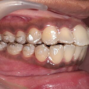Case done by Dr Gaurav Gupta at our clinic.