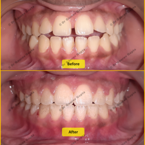 Case done by Dr Gaurav Gupta at our clinic-Before after comparison.
