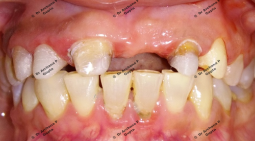 Done by Dr Archana Gupta at our clinic.