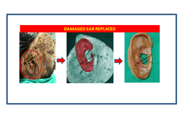 Ear silicone prosthesis done by Dr Archana Gupta for burn patient.