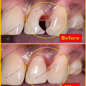 Before and after of tooth coloured anterior teeth fillings in different patients done at our clinic.