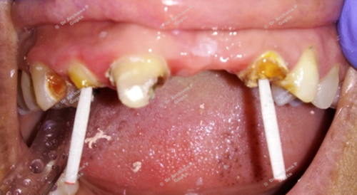 Done by Dr Archana Gupta at our clinic.
