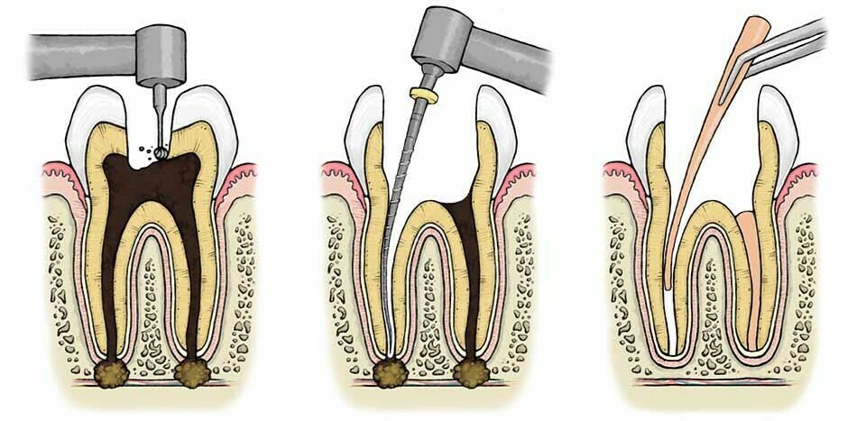 Basic steps in root canal treatment.