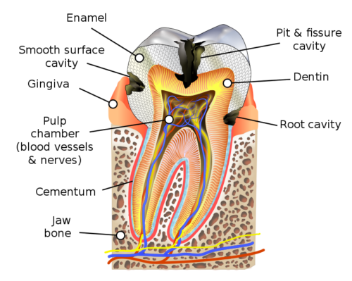 Dental caries affecting different parts of a tooth.